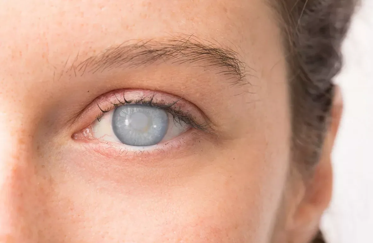 Is There a Way to Treat Cataracts Without Surgery?