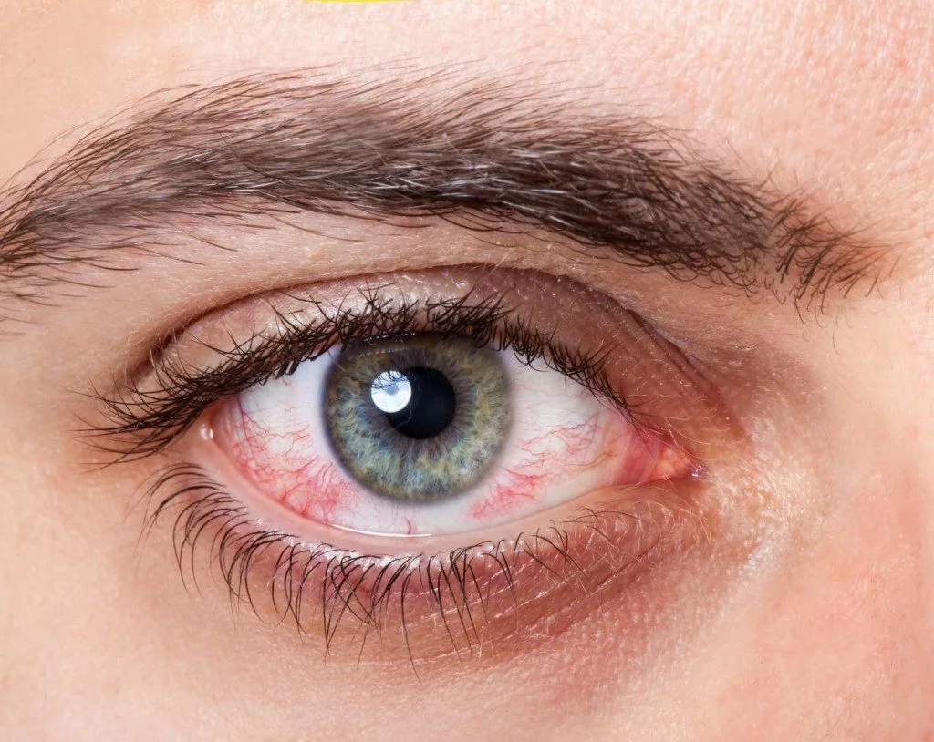 What is the Main Cause of Dry Eyes?